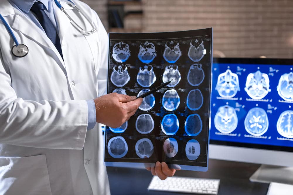 Skany mózgu pozwalają przewidzieć chorobę Alzheimera